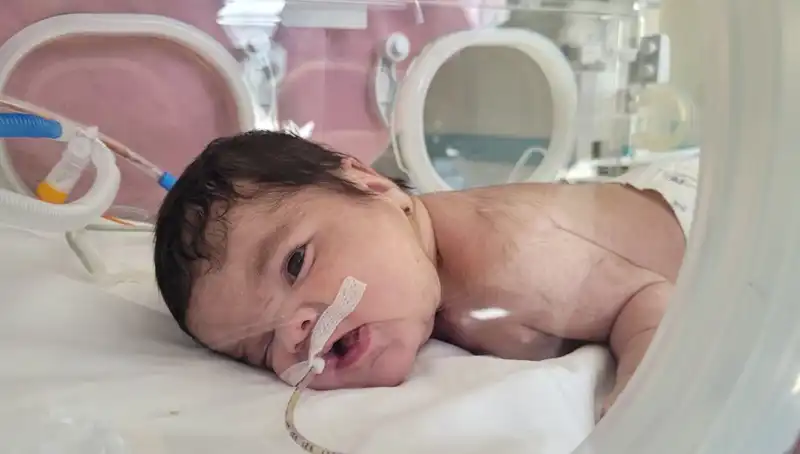 34 Haftalık Eymen Bebek: Dünyada 7. Kez Yaşanan Bir Tıp Mucizesi