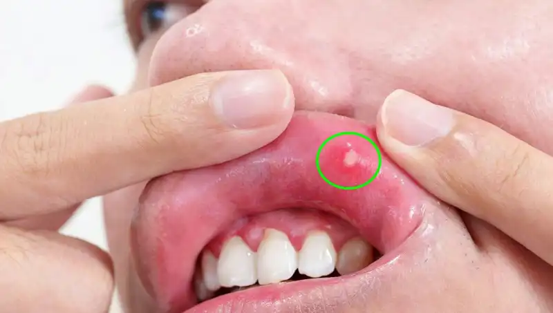 Kanser Belirtilerini Göz Ardı Eden Kadının Hikayesi: Tıbbi Bir Kurtuluş