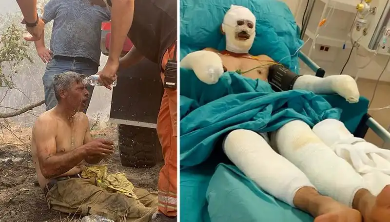 Orman İşçisinin Yanık Tedavisi Devam Ediyor: Hayat Mücadelesi